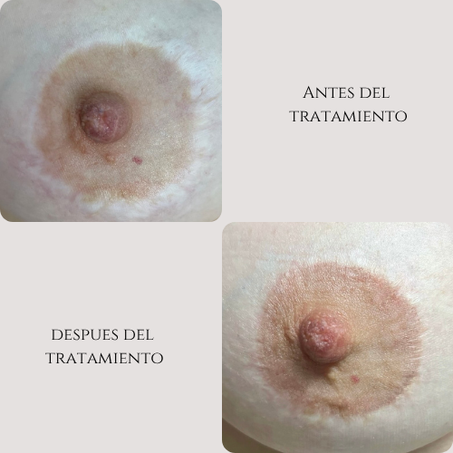 Micropigmentación de areolas mamarias - Imagen 2