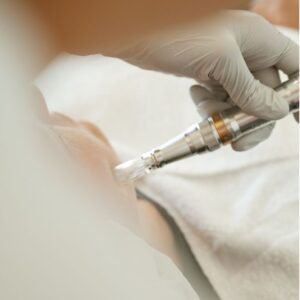 Microneedling tratamiento regeneración cutánea Sabadell