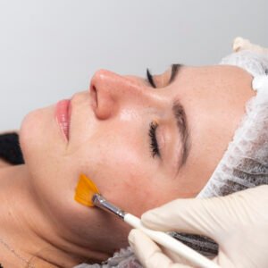 Peeling químico facial luminosidad piel Sabadell